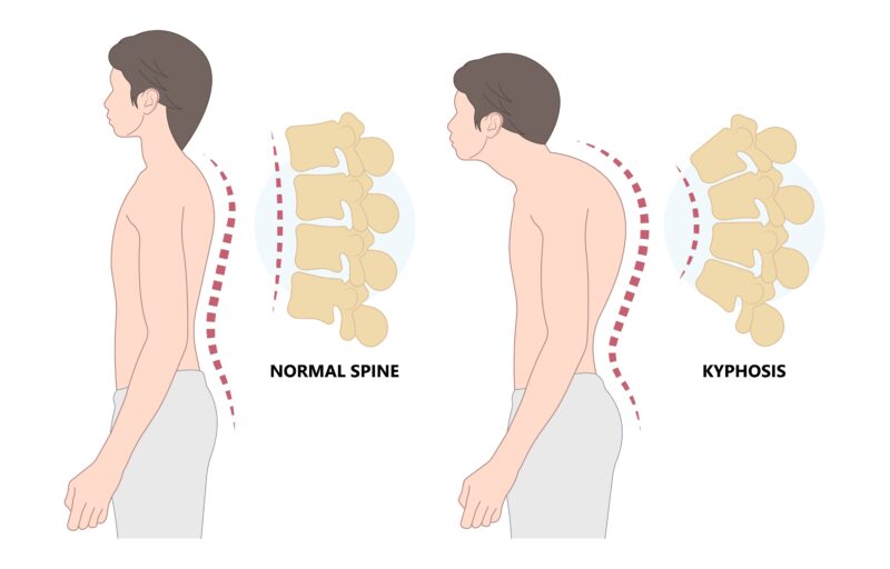 Kyphosis: Causes, Symptoms, and Treatments