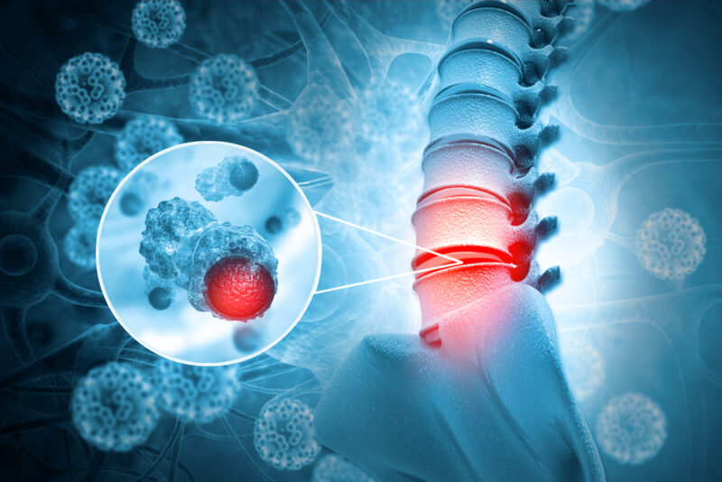 Spinal Tumors: Types, Symptoms, and Treatment Options