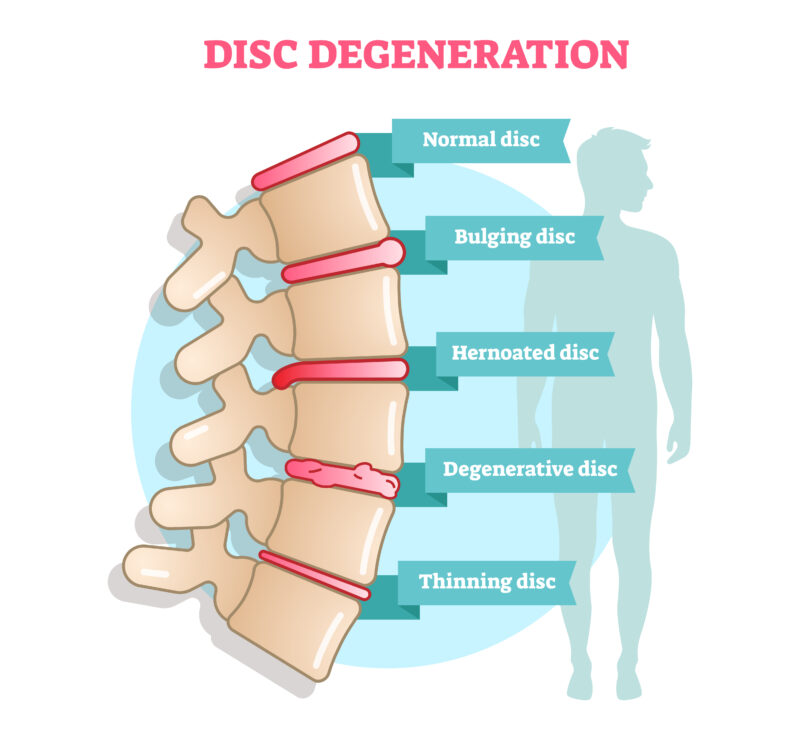 Disc Degeneration: Preventive Measures and Treatments