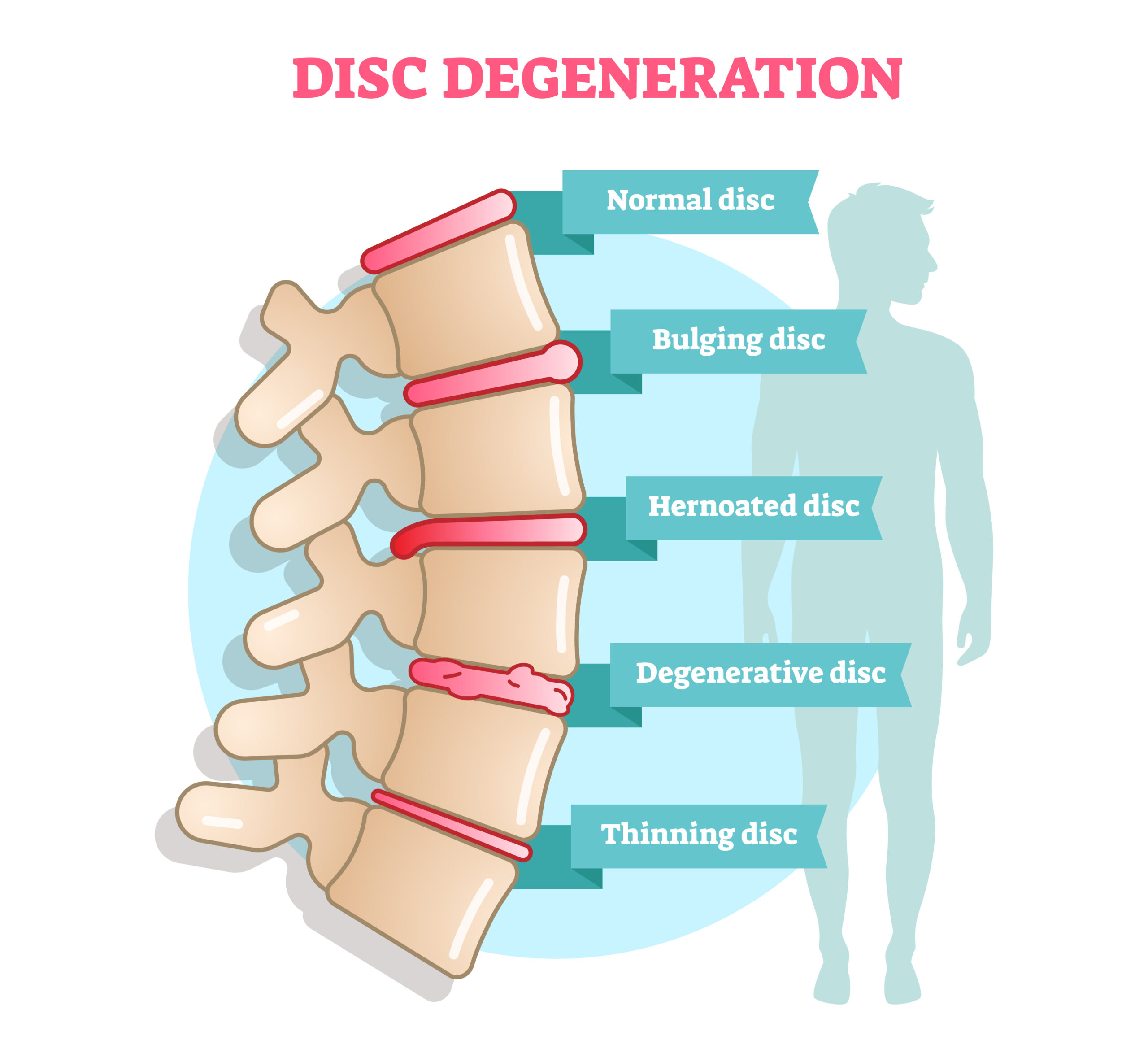 Disc Degeneration: Preventive Measures and Treatments