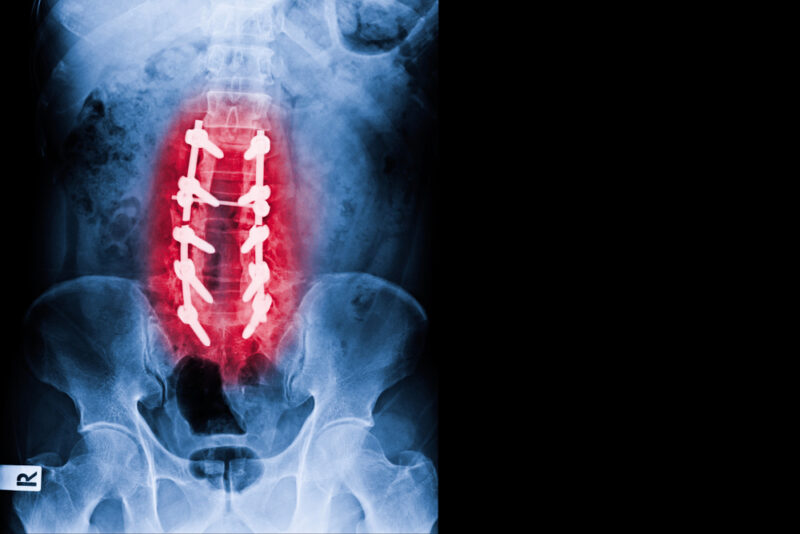 Understanding Spinal Fusion: When Is It Necessary?