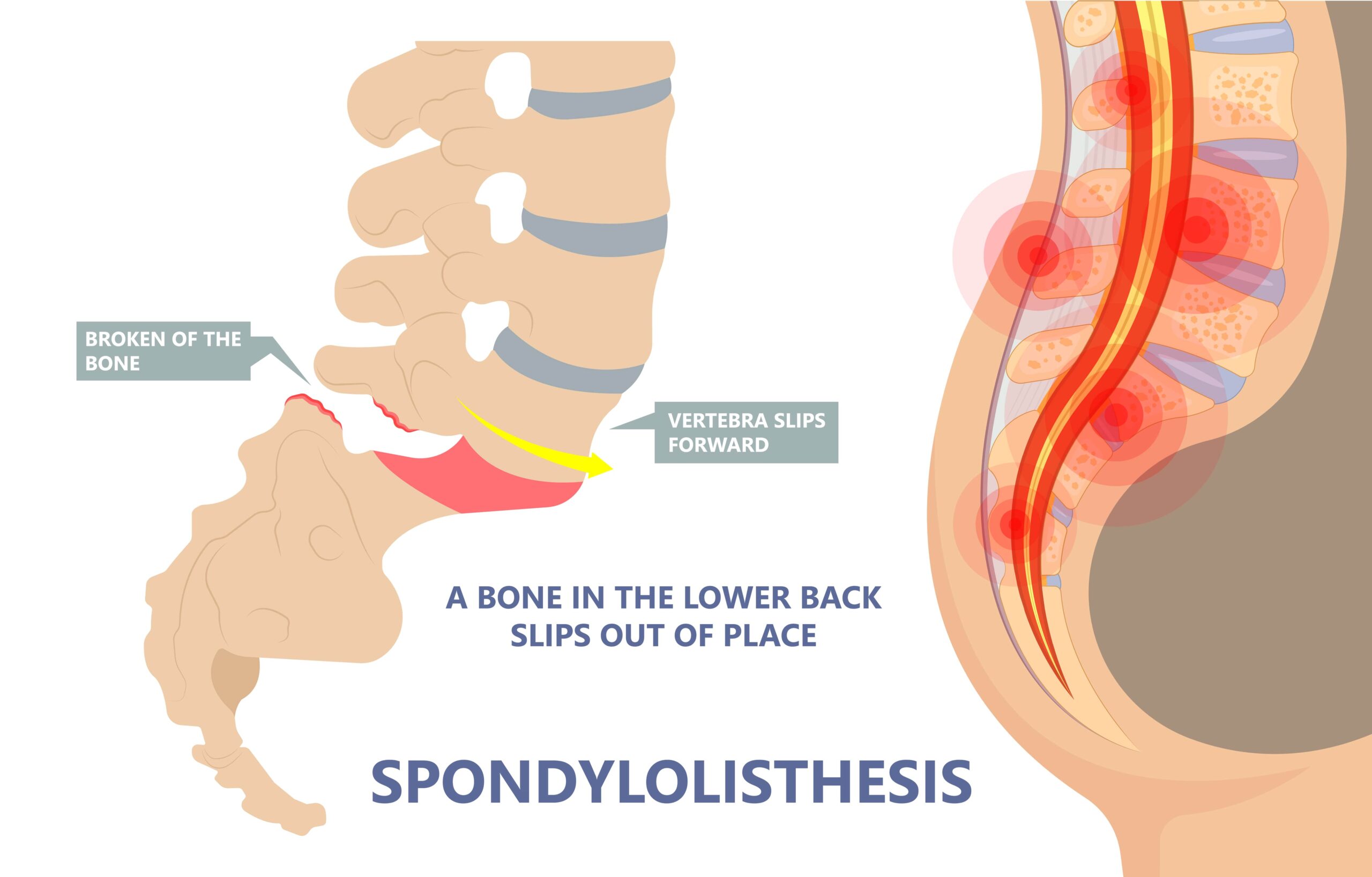What Is Spondylolisthesis and How to Treat It