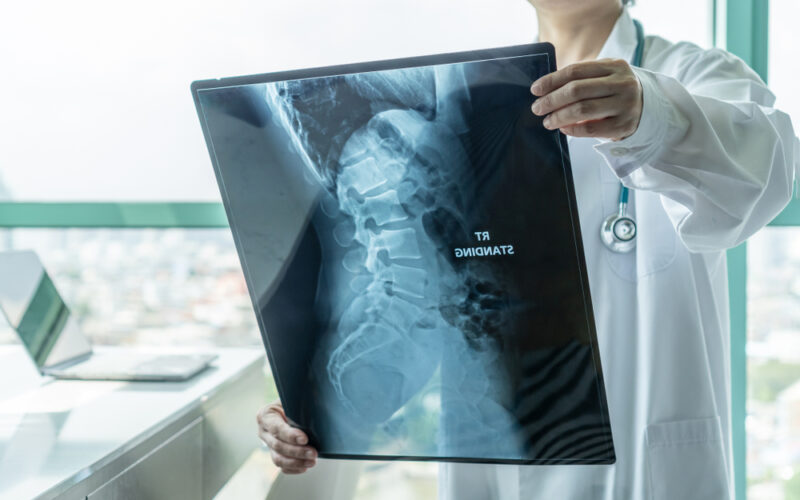 Surgical doctor looking at radiological spinal x-ray film for medical diagnosis on patient’s health on spine disease