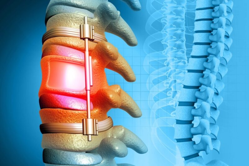 spinal column with implant, screw placement, 3d illustration