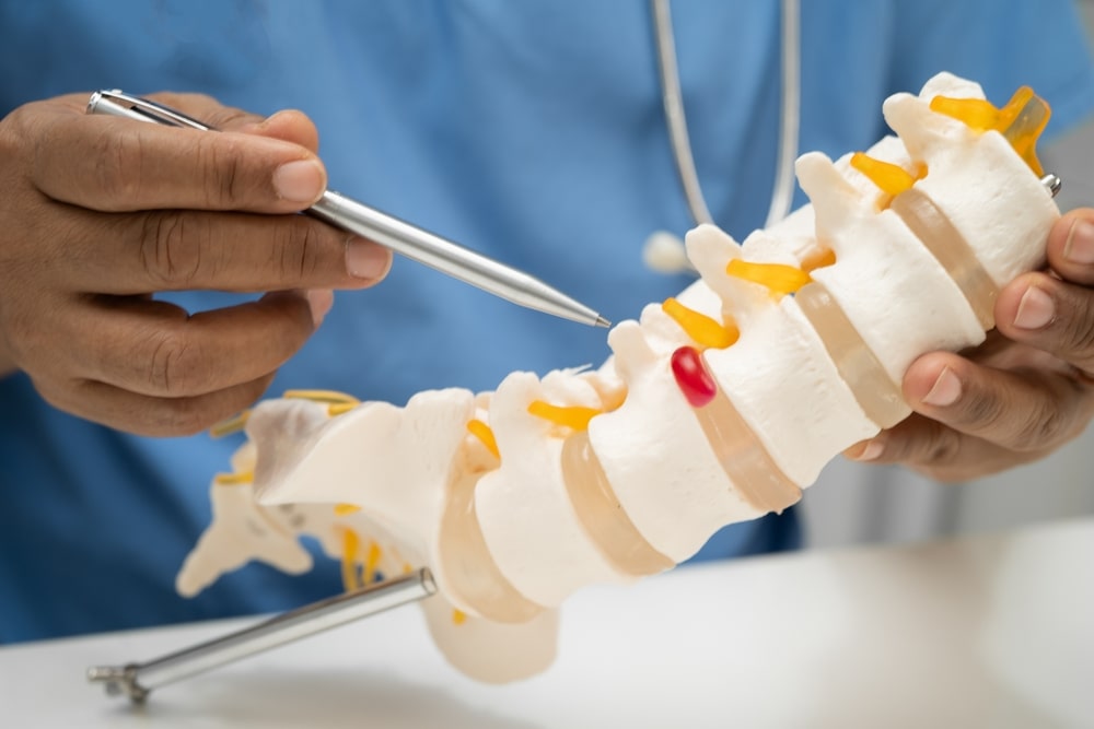 Asian doctor holding spinal nerve and bone model, Lumbar spine displaced herniated disc fragment