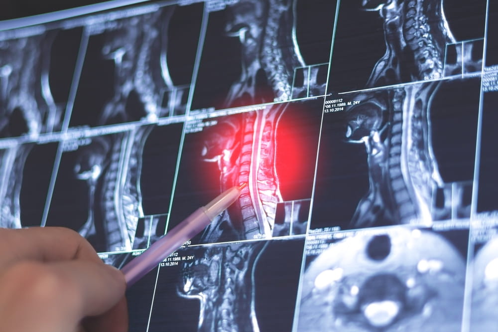 Doctor examining MRI neck spine. X-ray scan. Spondylosis of the cervical spine