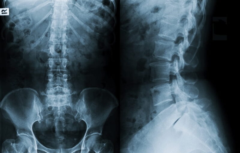 Film x-ray lumbar spine , L-S spine (AP,Lateral view)