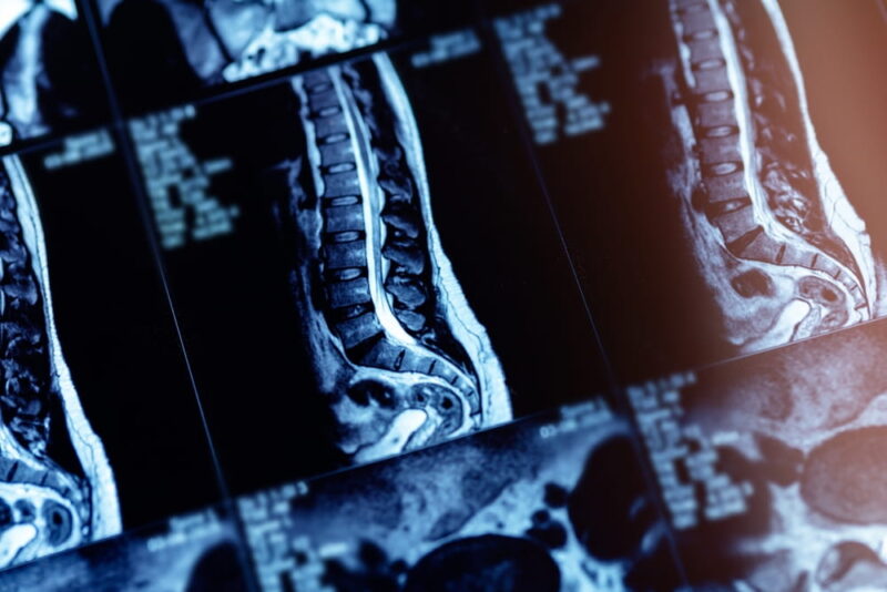 Mri scan of spinal column showing disc protrusion in adult patient.