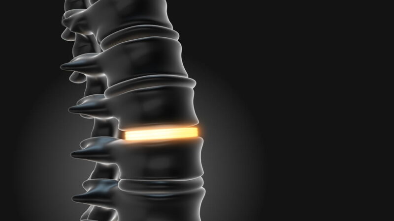 Lumbar Implants Stabilize the Spine 3D illustration
