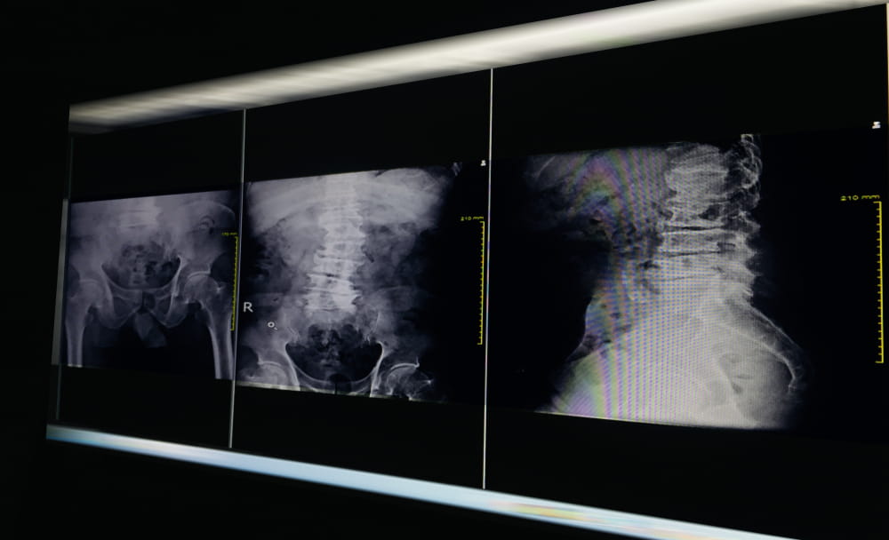 Dark x-ray image lumbar spine and pelvic bone with hip joint finding degenerative change L4-5 lumbar Scoliosis,Medical healthcare concept.