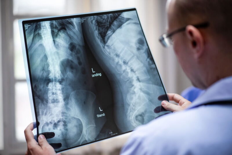 A medical professional examines spinal X-rays, focusing on the lumbar region