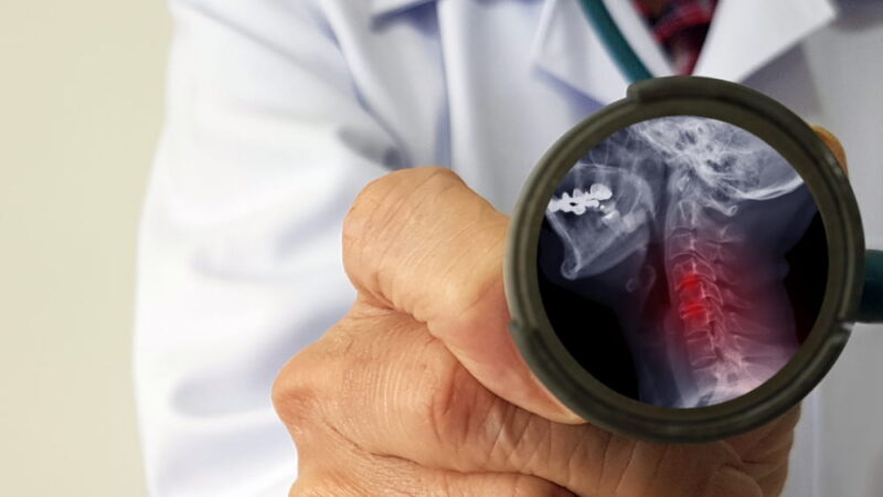 Orthopedist doctor check film X-ray of cervical spine spondylosis which is spinal disc degenerative disease.