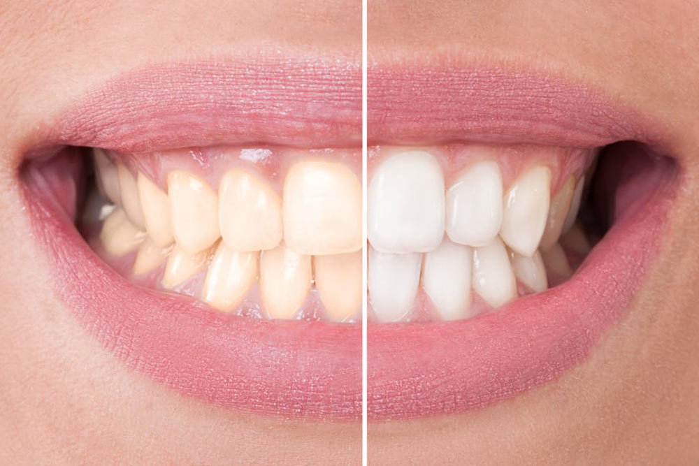 before and after dental whitening treatment