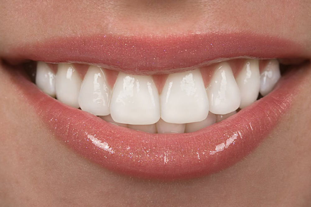 close up of teeth after veneer treatment