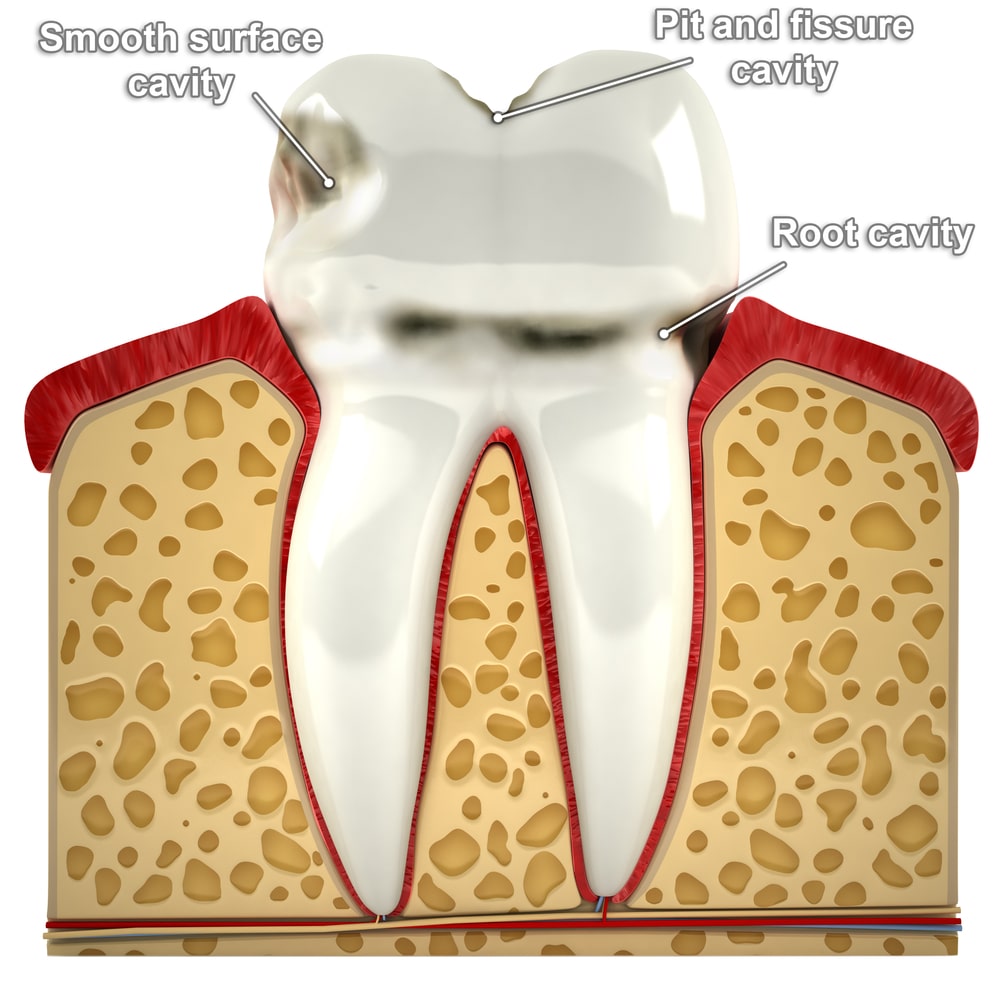 different types of cavities