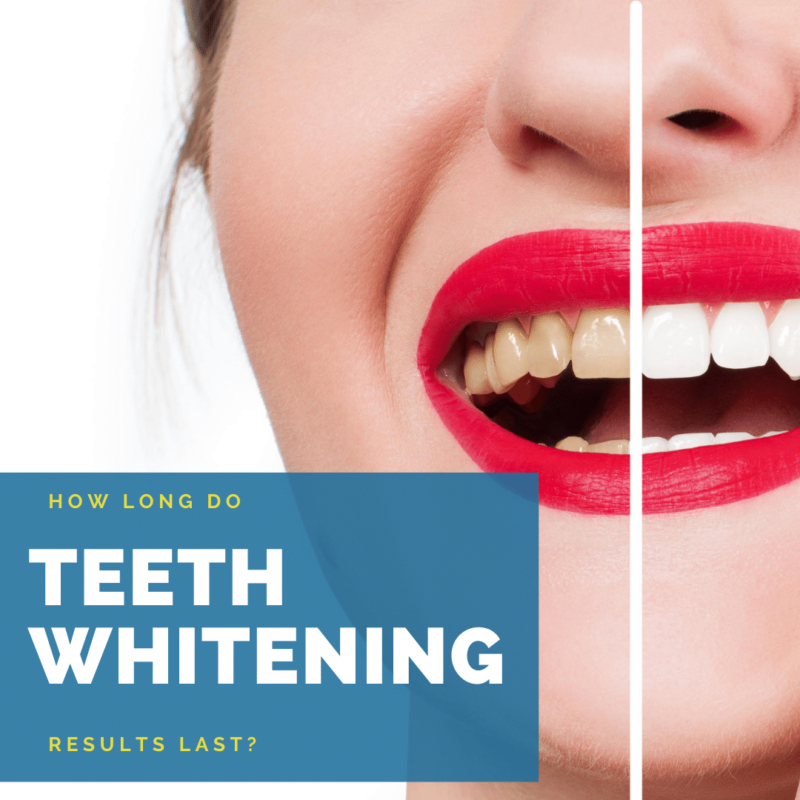 How long do teeth whitening results last