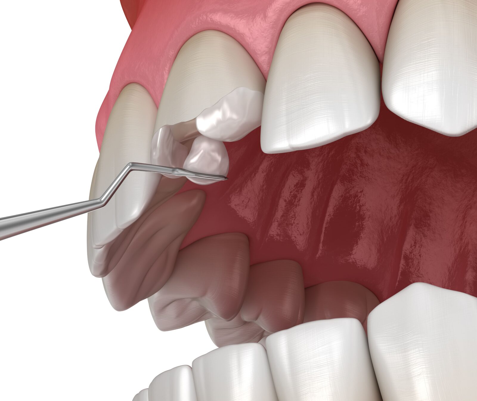 composite bonding on a broken tooth