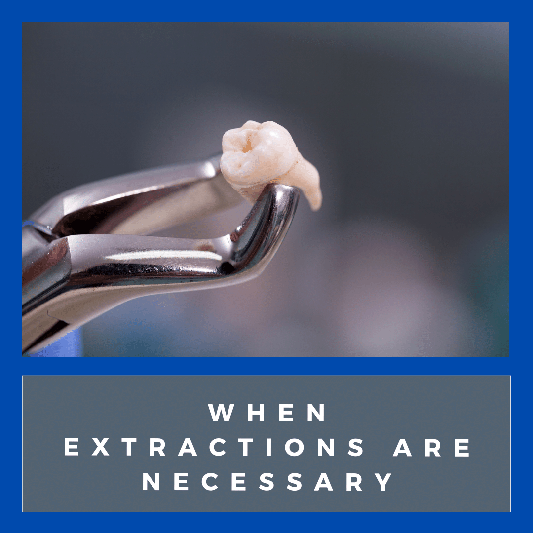 When Extractions are Necessary