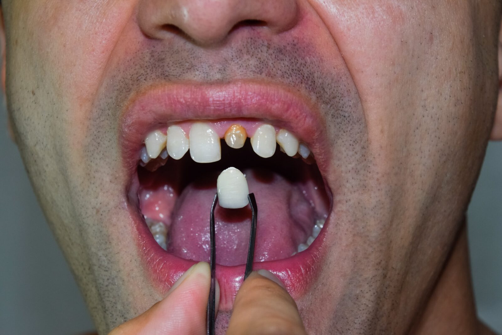 man with broken tooth getting a dental crown