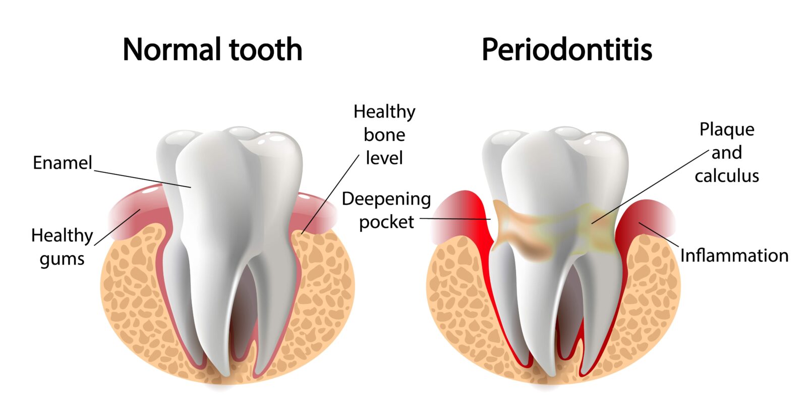 normal tooth vs periodontitis