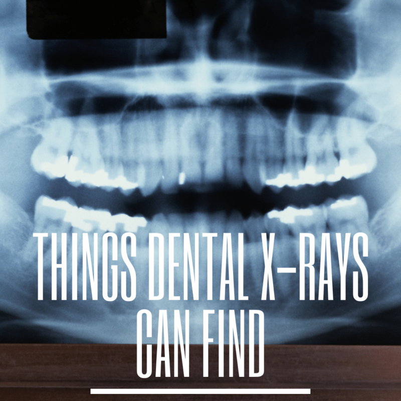 Things Dental X-Rays Can Find (1)