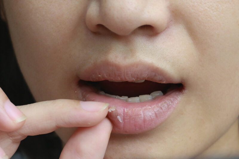 Dry, chapped, peeling lips :dry skin problem with mouth disease