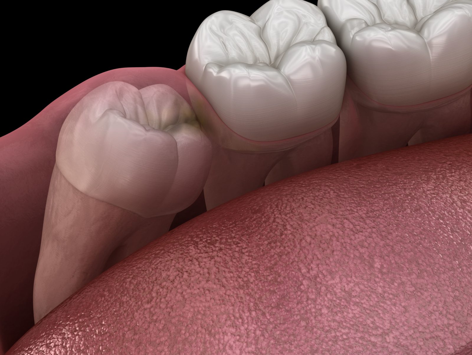 impacted molar