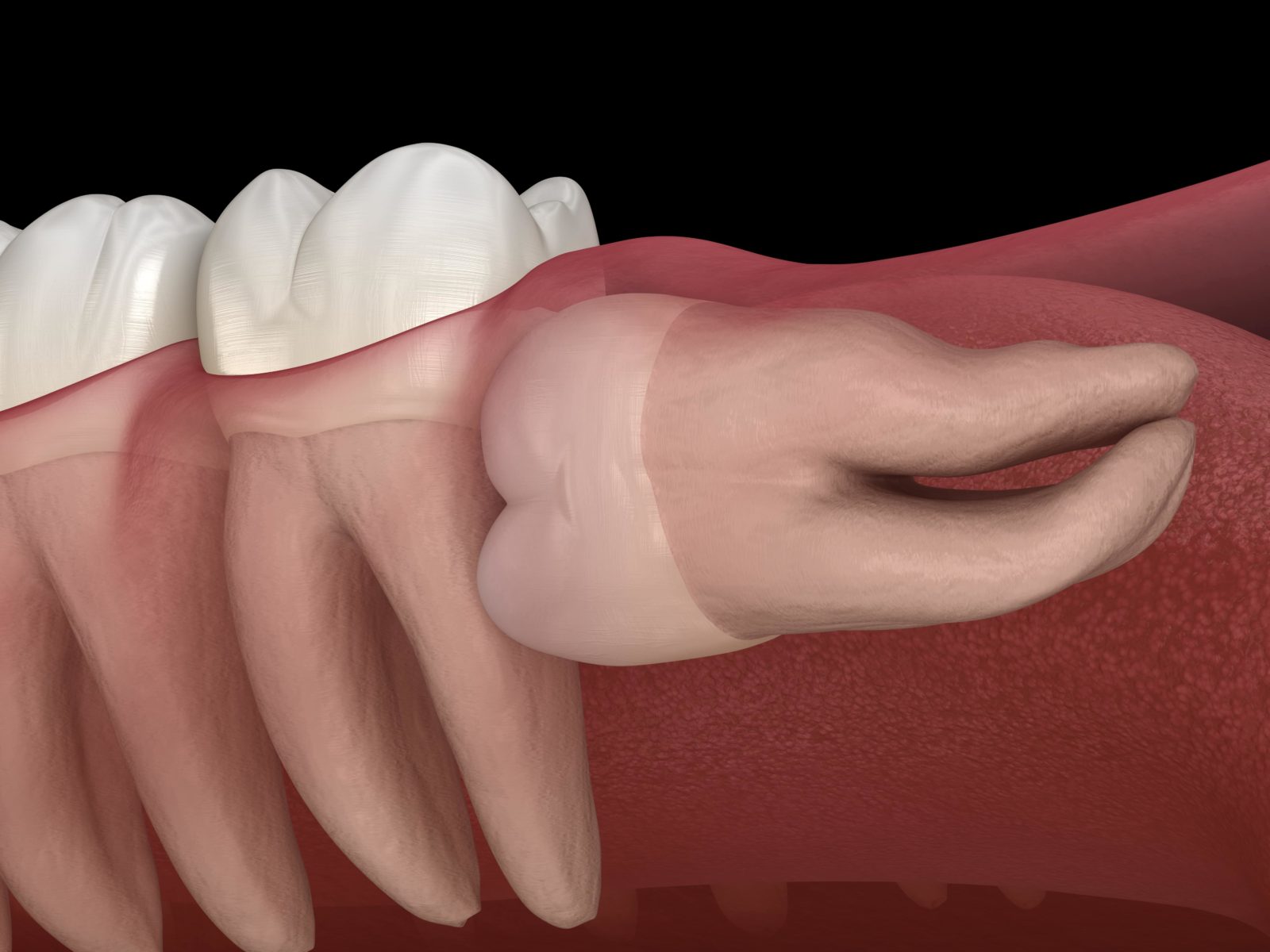 tooth growing sideways