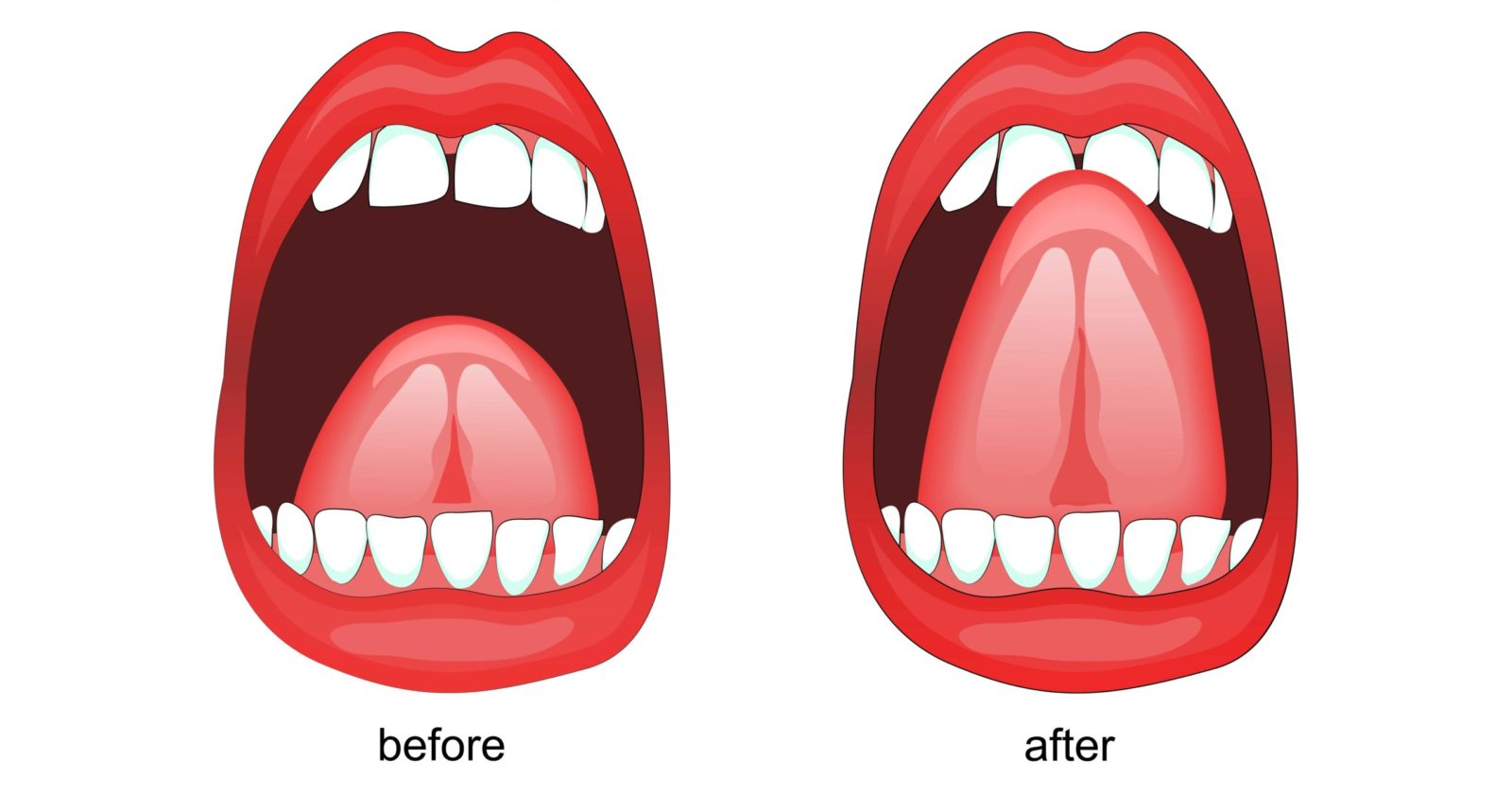 before and after frenectomy