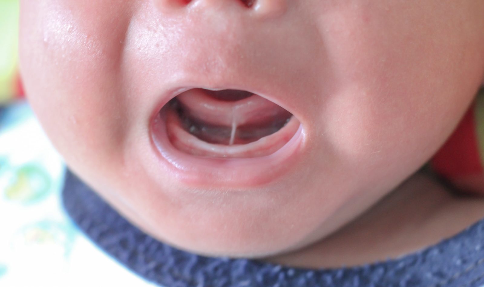 newborn with tongue tie