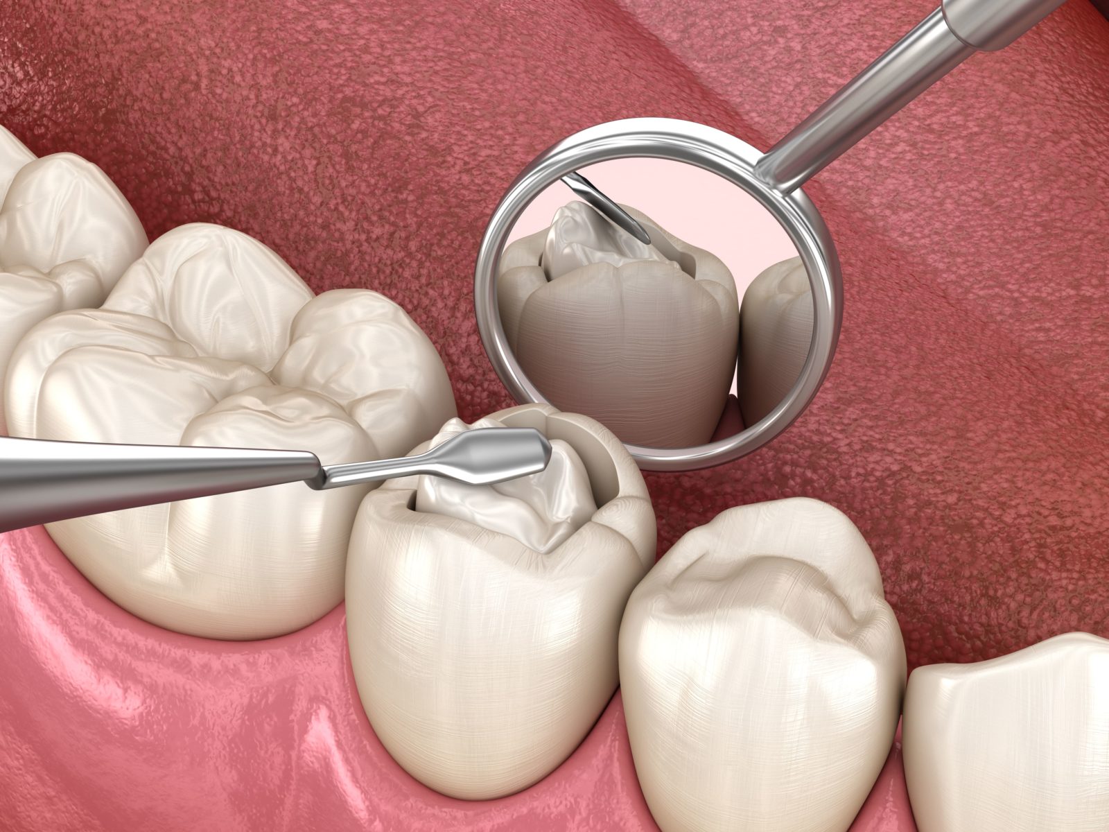 composite resin being placed in a cavity