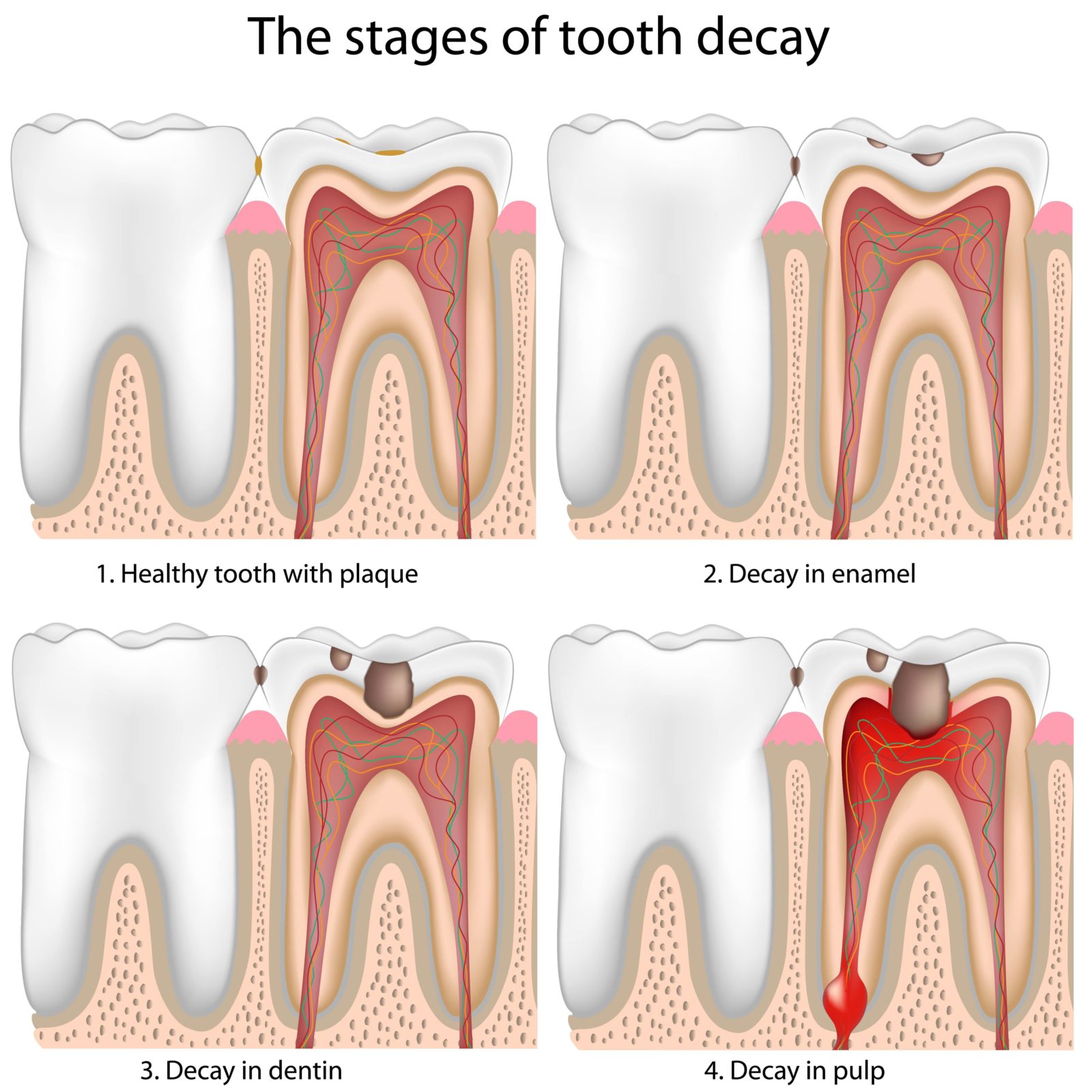 cavity