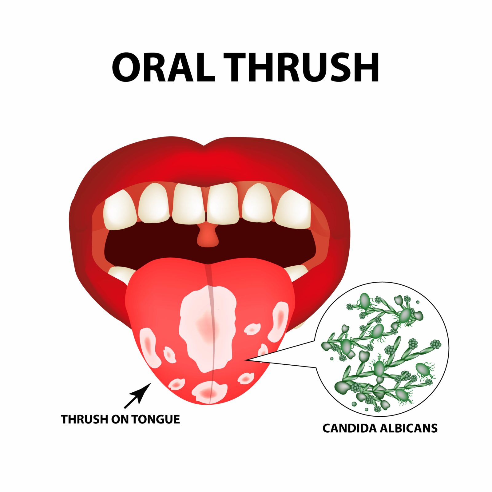 Oral Thrush Babies Gums