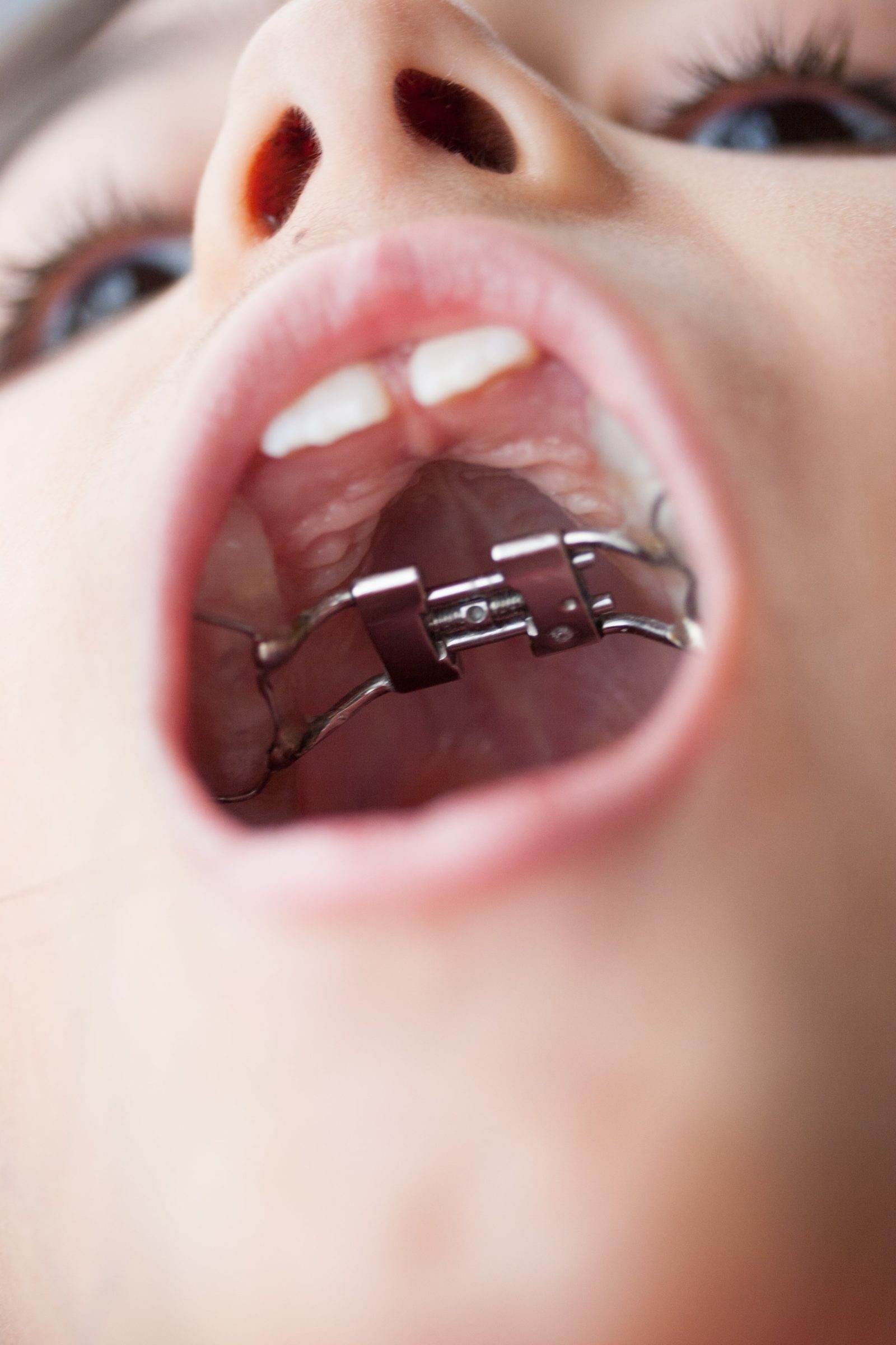 child opening their mouth to show a palate expander orthodontic appliance