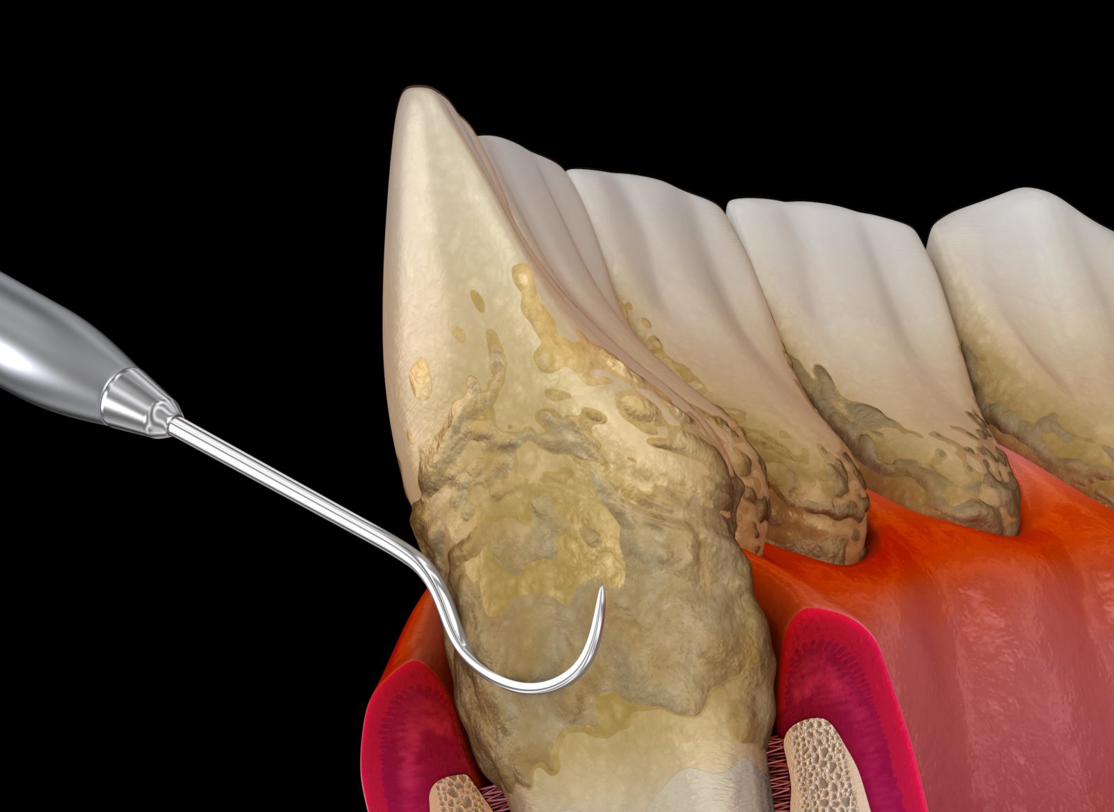 deep cleaning for gum disease