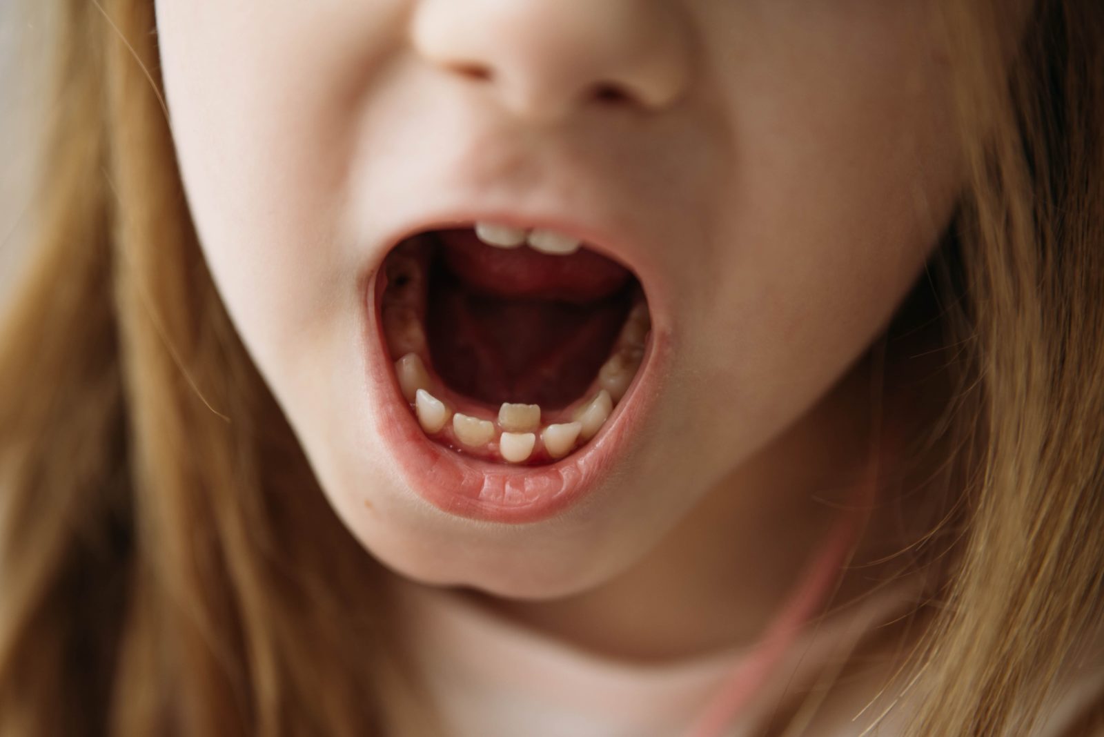young girl with over-retained baby tooth