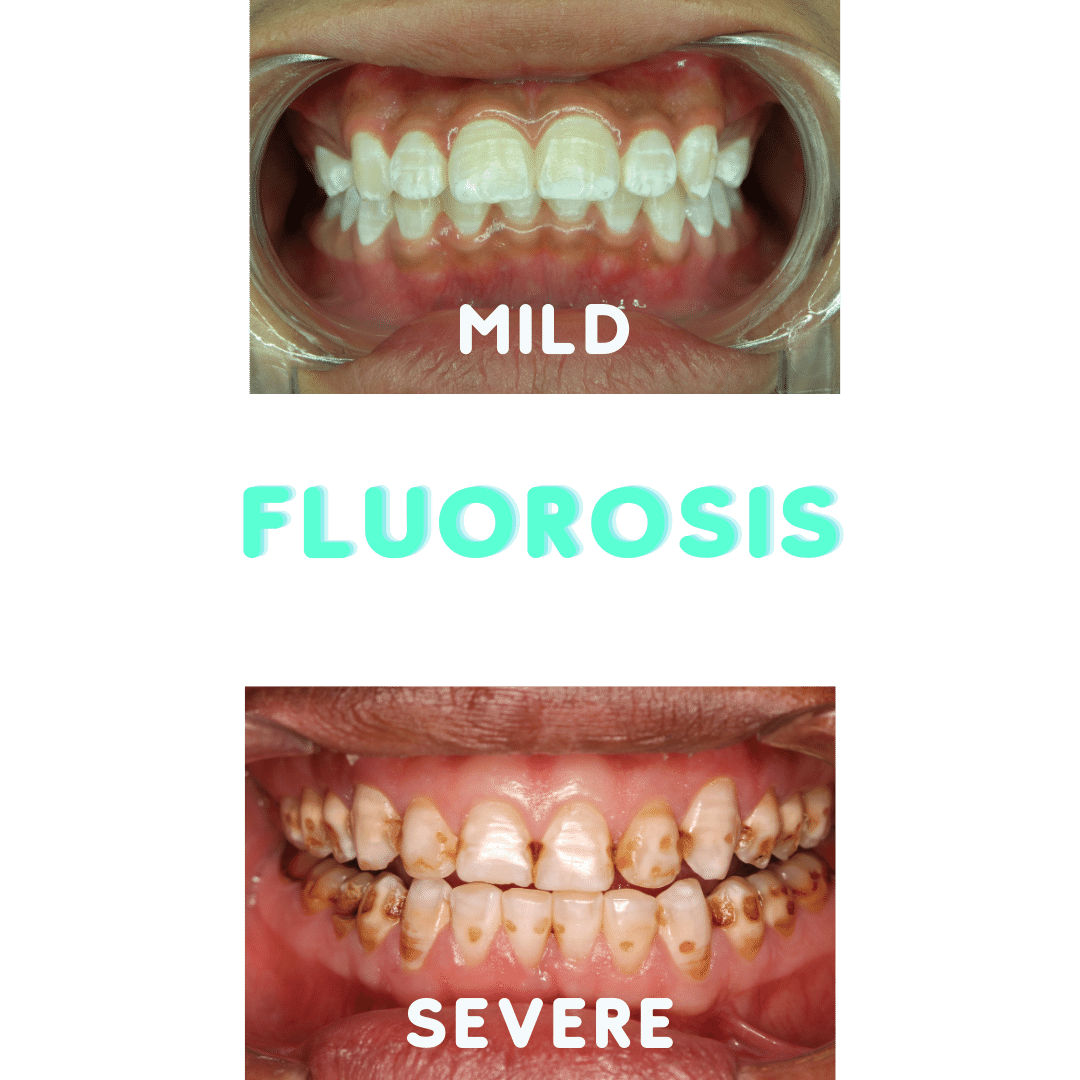 Ways To Prevent Fluorosis Acorn Dentistry For Kids