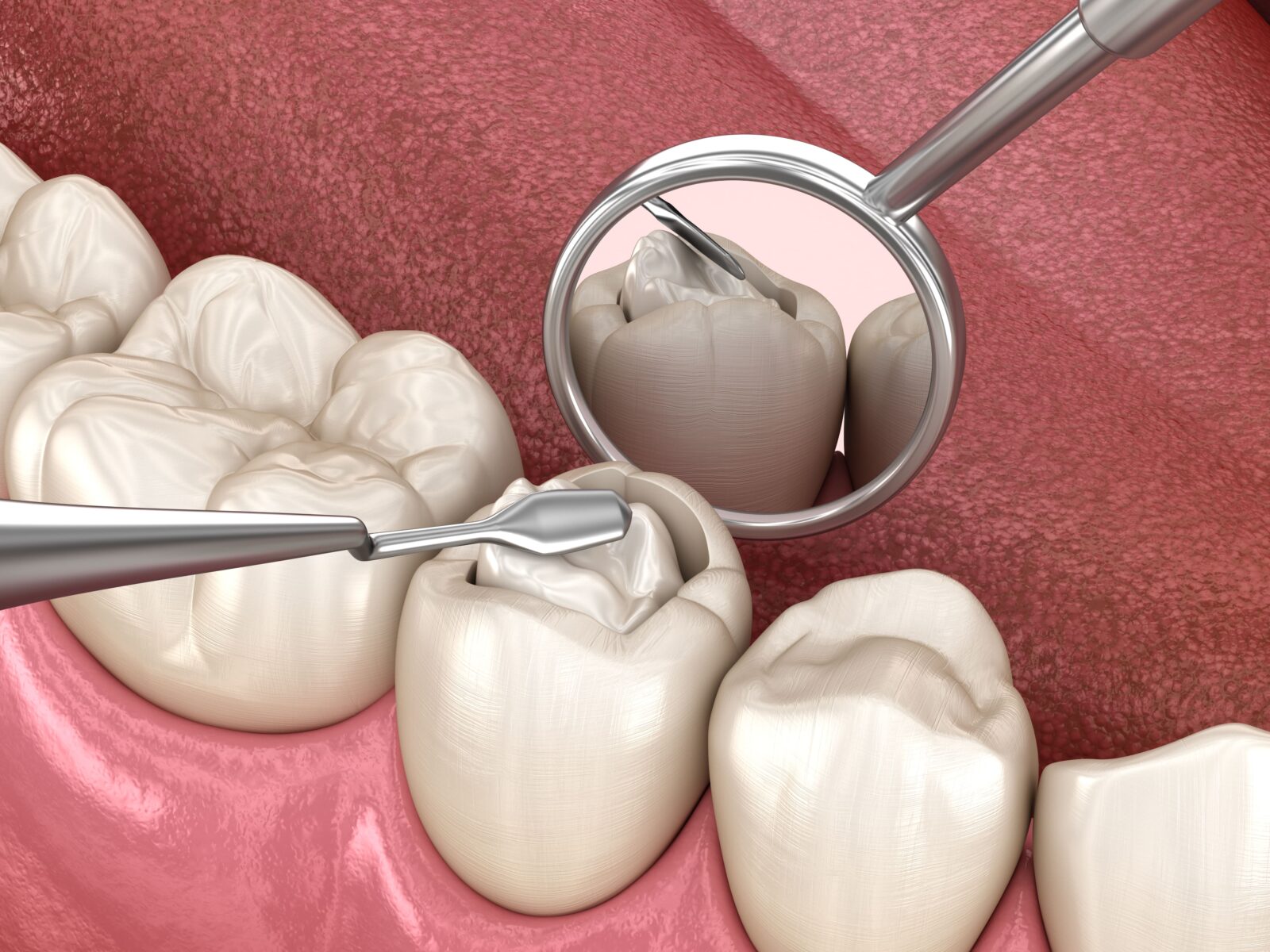 composite being placed in a dental cavity