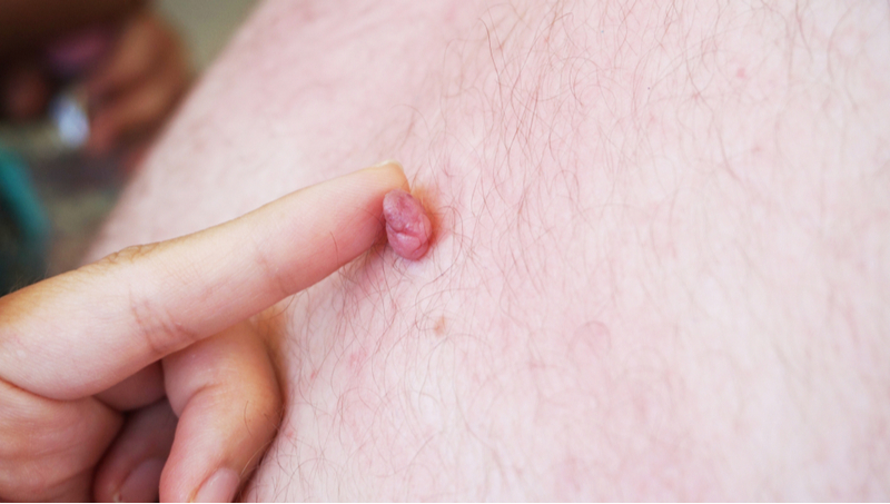 skin tags