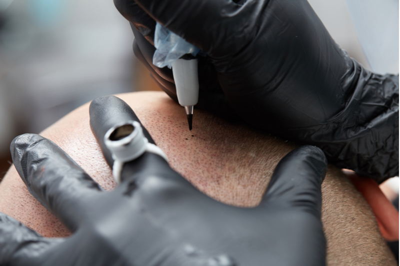scalp migropigmentation procedure