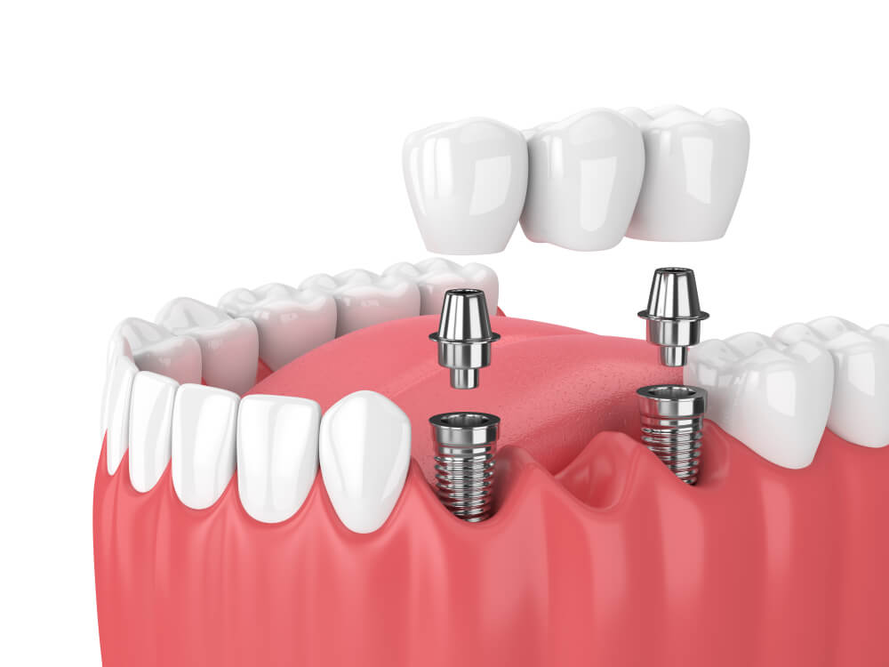 dental implant restoration illustration