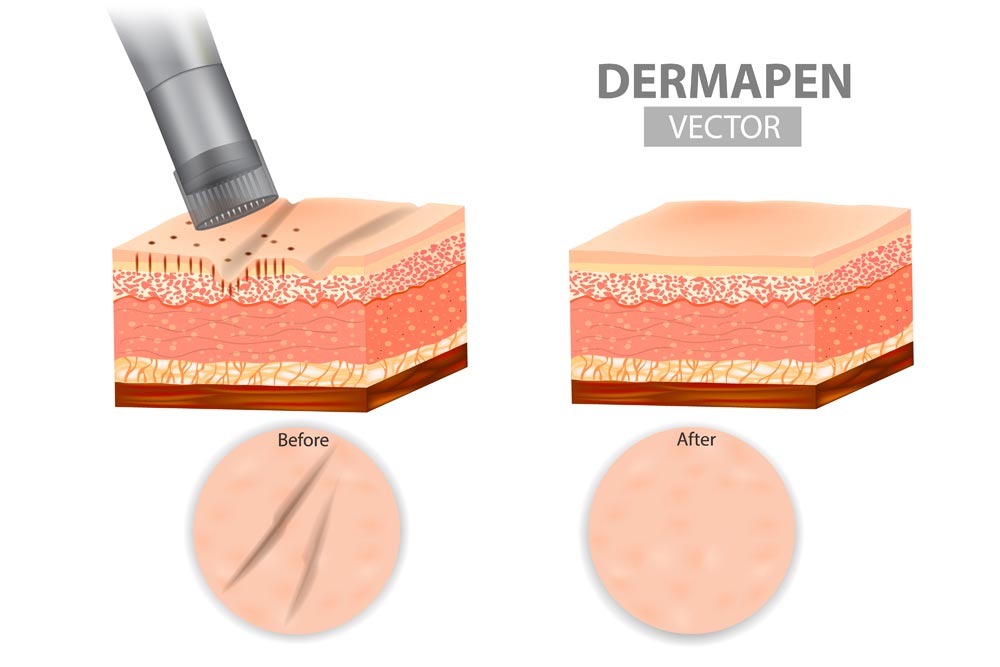 Microneedeling before and after
