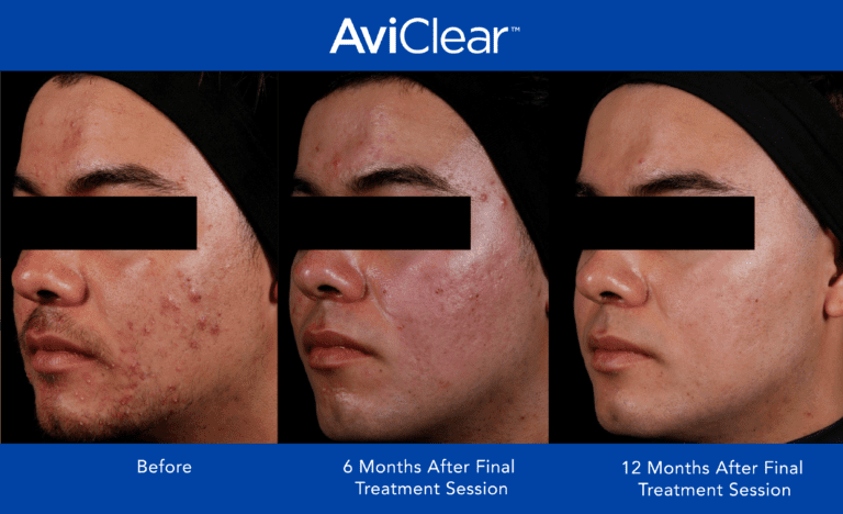 AviClear Before and After teen boy 768x468 1 showing the concept of Services