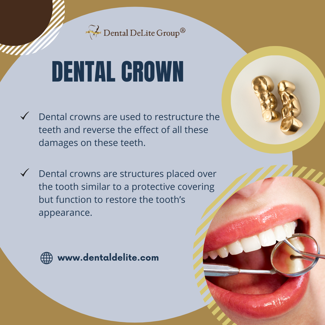 Dental Crowns in Dallas and Duncanville, TX