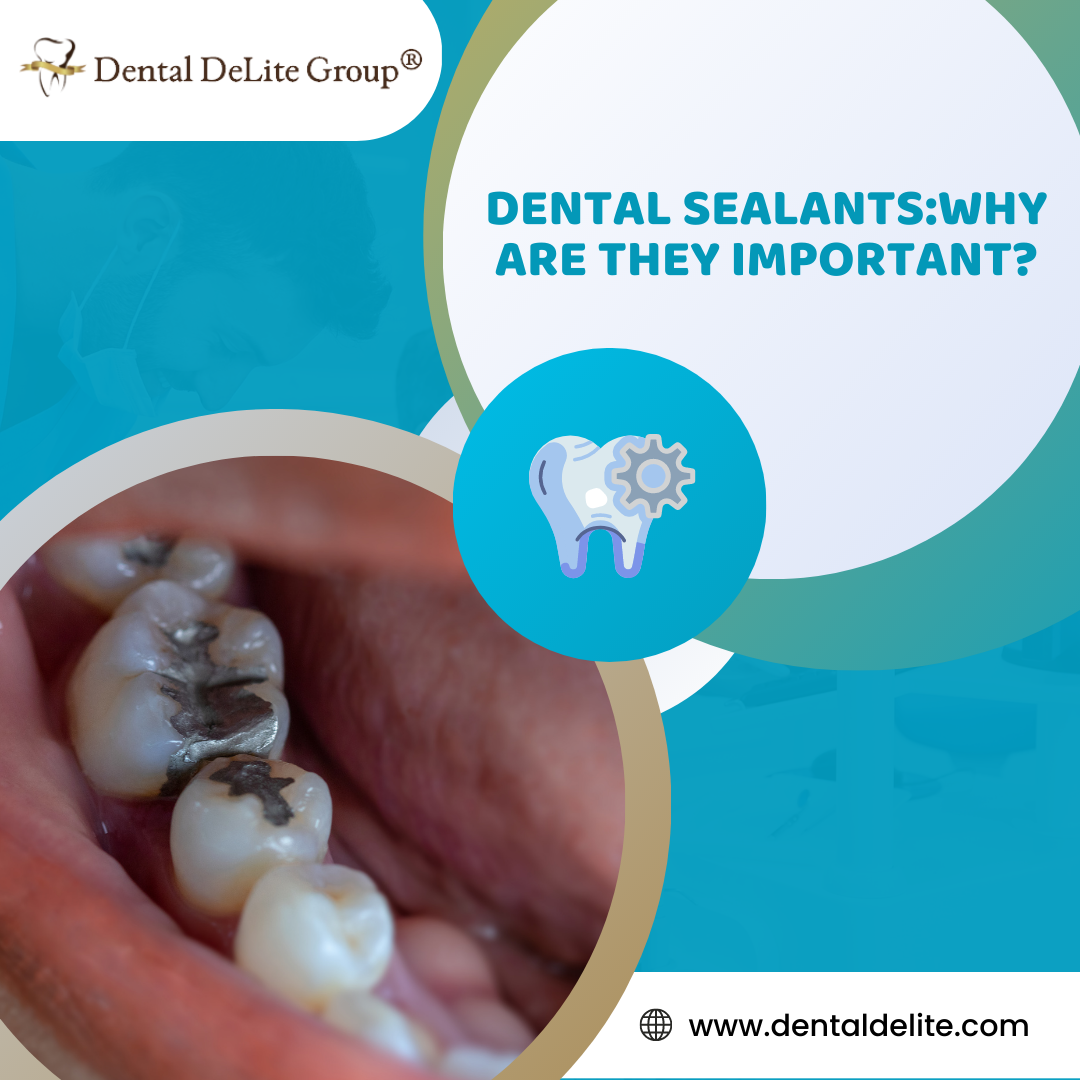 Dental Sealants in Dallas and Duncanville, TX Why Are They Important