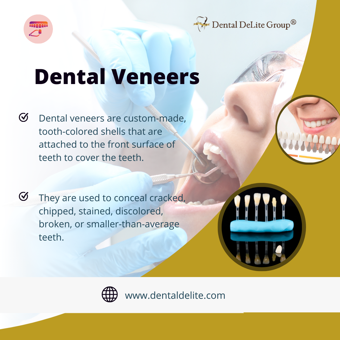 Dental Veneers in Dallas, Duncanville, TX