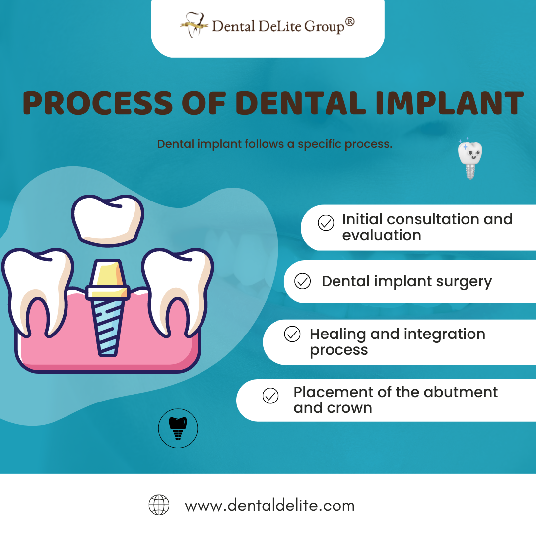 Process of Dental Implant in Dallas, & Duncanville, TX