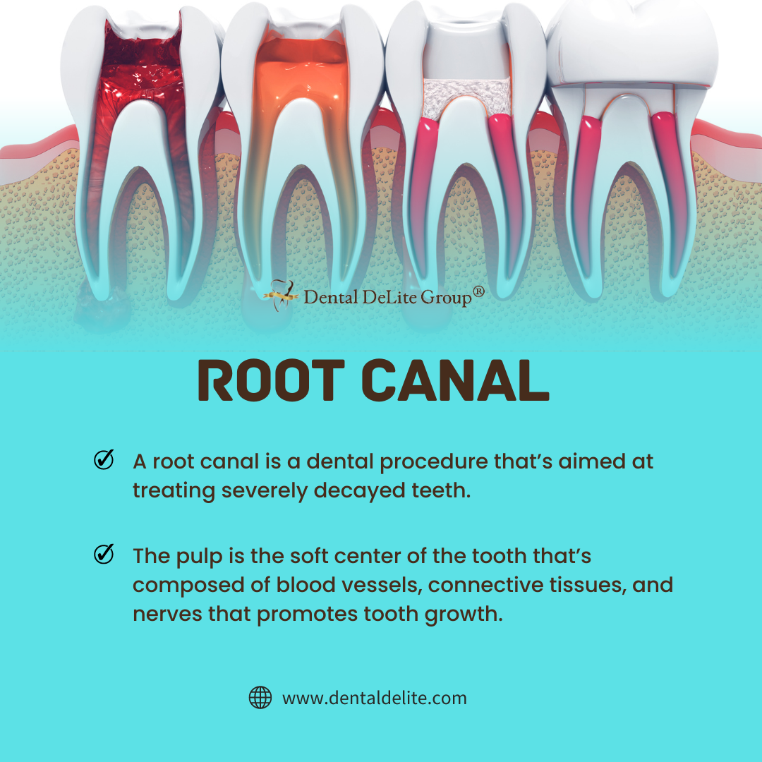 Root Canal in Dallas & Duncanville, Tx