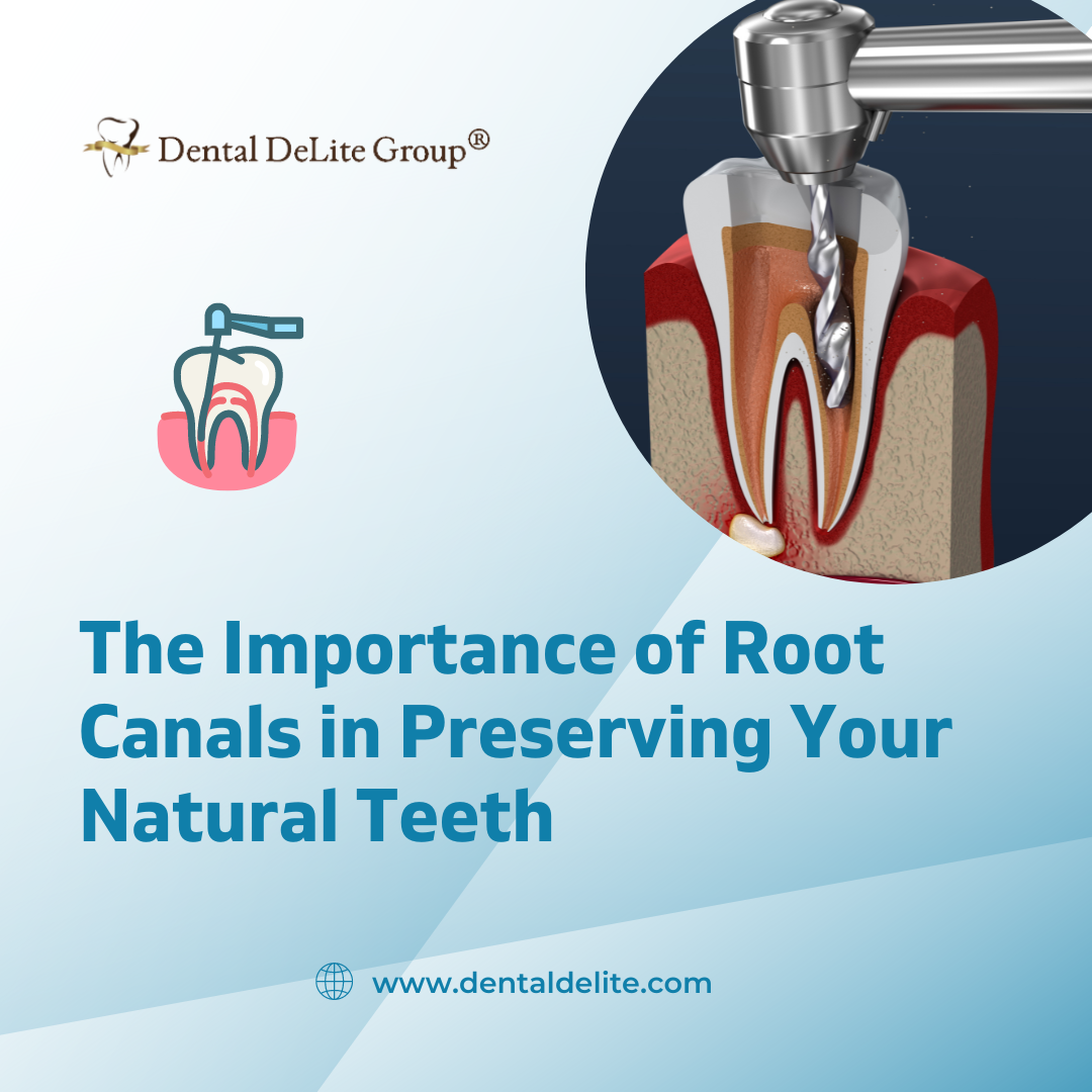 The Importance of Root Canals in Preserving Your Natural Teeth – Dallas & Duncanville, Tx