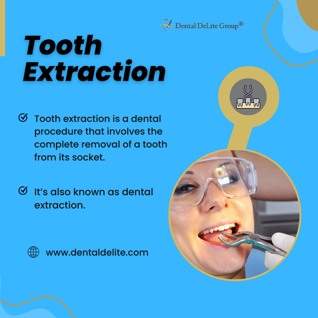 Tooth Extraction in Dallas and Duncanville, TX
